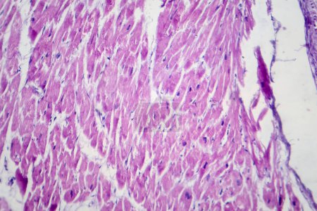Photomicrograph of cardiac hypertrophy showing enlarged and thickened cardiac muscle fibers under the microscope.