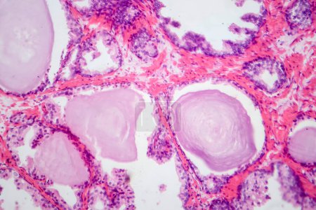 Fotomicrografía que muestra características histológicas de la hiperplasia prostática benigna. Glándula prostática agrandada con proliferación nodular de componentes glandulares y estromales.