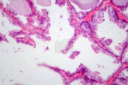 Fotografische Aufnahme mit histologischen Merkmalen der gutartigen Prostatahyperplasie. Vergrößerte Prostata mit knotiger Proliferation von Drüsen- und Stromakomponenten.