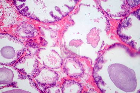 Photomicrograph showing histological features of benign prostatic hyperplasia. Enlarged prostate gland with nodular proliferation of glandular and stromal components.