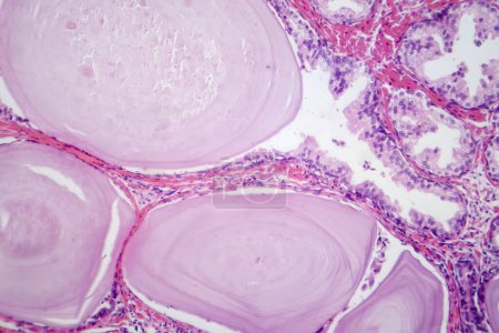 Photomicrographie montrant les caractéristiques histologiques de l'hyperplasie bénigne de la prostate. Élargissement de la prostate avec prolifération nodulaire des composants glandulaires et stromaux.