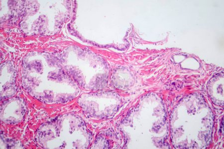 Fotografische Aufnahme mit histologischen Merkmalen der gutartigen Prostatahyperplasie. Vergrößerte Prostata mit knotiger Proliferation von Drüsen- und Stromakomponenten.