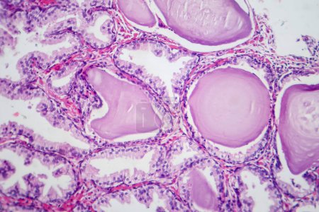Photo for Photomicrograph showing histological features of benign prostatic hyperplasia. Enlarged prostate gland with nodular proliferation of glandular and stromal components. - Royalty Free Image