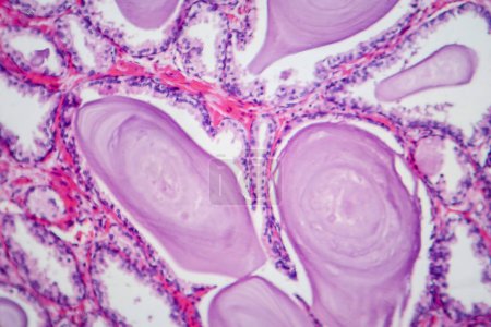 Téléchargez les photos : Photomicrographie montrant les caractéristiques histologiques de l'hyperplasie bénigne de la prostate. Élargissement de la prostate avec prolifération nodulaire des composants glandulaires et stromaux. - en image libre de droit