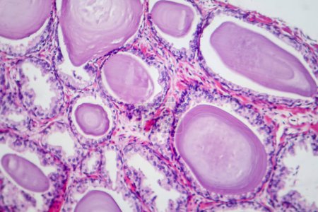 Photomicrographie montrant les caractéristiques histologiques de l'hyperplasie bénigne de la prostate. Élargissement de la prostate avec prolifération nodulaire des composants glandulaires et stromaux.
