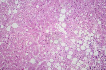 Foto de Micrografía ligera que revela tejido hepático con infiltración grasa, indicativa de esteatosis hepática o enfermedad hepática grasa. - Imagen libre de derechos