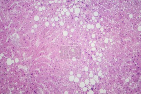 Leichte Mikrographie, die Lebergewebe mit Fettinfiltration zeigt, das auf Lebersteatose oder Fettlebererkrankungen hinweist.