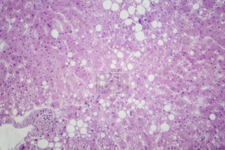 Micrografía ligera que revela tejido hepático con infiltración grasa, indicativa de esteatosis hepática o enfermedad hepática grasa.