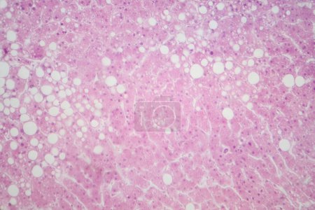 Light micrograph revealing liver tissue with fatty infiltration, indicative of hepatic steatosis or fatty liver disease.