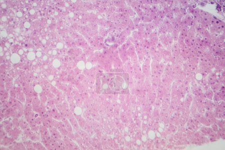 Téléchargez les photos : Micrographie photonique révélant le tissu hépatique avec infiltration graisseuse, indiquant une stéatose hépatique ou une stéatose hépatique graisseuse. - en image libre de droit