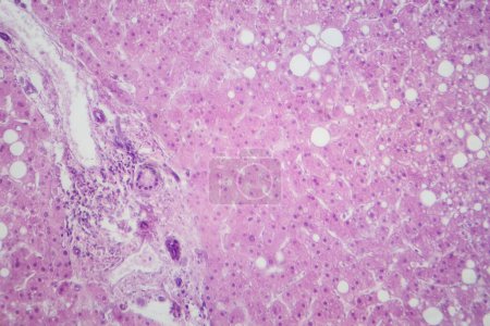 Foto de Micrografía ligera que revela tejido hepático con infiltración grasa, indicativa de esteatosis hepática o enfermedad hepática grasa. - Imagen libre de derechos