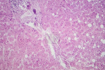 Micrographie photonique révélant le tissu hépatique avec infiltration graisseuse, indiquant une stéatose hépatique ou une stéatose hépatique graisseuse.