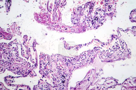 Photomicrograph of smoker's lung, revealing characteristic changes and damage associated with long-term smoking habits.