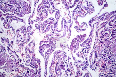 Photo for Photomicrograph of smoker's lung, revealing characteristic changes and damage associated with long-term smoking habits. - Royalty Free Image