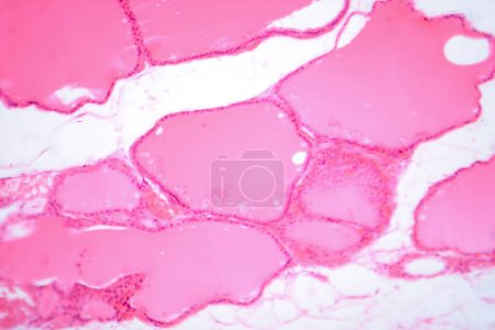 Photomicrograph of a normal thyroid gland under a microscope, exhibiting typical follicular structure and colloid-filled follicles.
