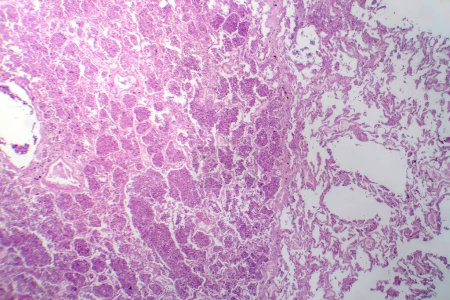 Photomicrograph of lobar pneumonia in grey hepatic phase, revealing lung tissue transition with exudate-filled alveoli.