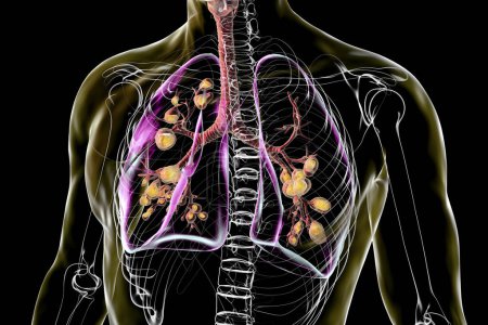 Poumons affectés par la mucoviscidose, un trouble génétique causant une production épaisse de mucus. Illustration 3D montrant une dilatation bronchique due à l'accumulation de mucus et à l'inflammation.
