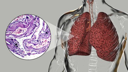 Foto de Una persona con pulmones de fumador, ilustración 3D junto con una imagen fotomicrográfica de los pulmones afectados por el tabaquismo. - Imagen libre de derechos