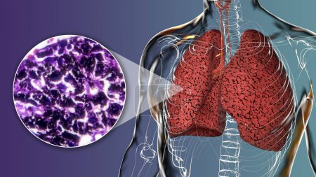A person with smoker's lungs, 3D illustration along with a photomicrograph image of lungs affected by smoking.