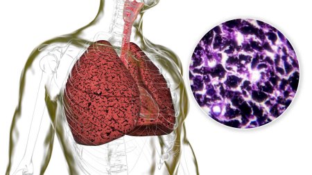 A person with smoker's lungs, 3D illustration along with a photomicrograph image of lungs affected by smoking.