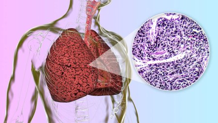 Foto de Una persona con pulmones de fumador, ilustración 3D junto con una imagen fotomicrográfica de los pulmones afectados por el tabaquismo. - Imagen libre de derechos