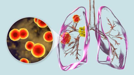 Blastomycose pulmonaire avec lésions pulmonaires et ganglions lymphatiques bronchiques dilatés, et vue rapprochée du champignon Blastomyces dermatitidis, illustration 3D.