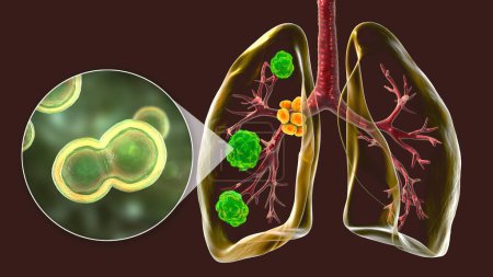 Blastomycose pulmonaire avec lésions pulmonaires et ganglions lymphatiques bronchiques dilatés, et vue rapprochée du champignon Blastomyces dermatitidis, illustration 3D.