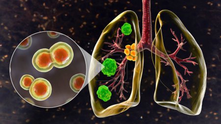 Blastomicosis pulmonar con lesiones pulmonares y ganglios linfáticos bronquiales agrandados, y vista de cerca del hongo Blastomyces dermatitidis, ilustración 3D.