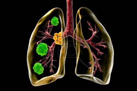 Blastomycose pulmonaire avec lésions pulmonaires et ganglions lymphatiques bronchiques dilatés, illustration 3D.
