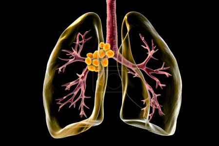 Ilustración 3D intrincada que revela linfadenitis mediastínica dentro de los pulmones humanos transparentes.