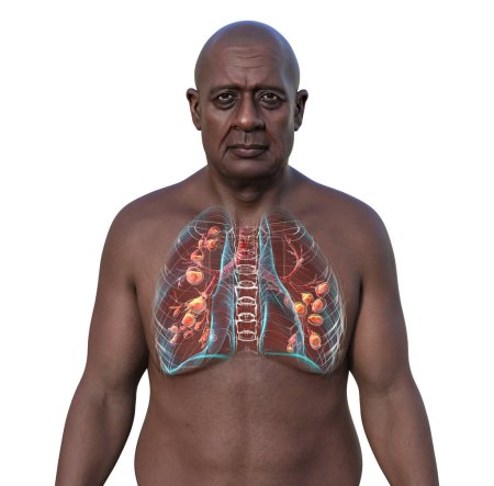 A man with lungs affected by cystic fibrosis, a genetic disorder causing thick mucus production. 3D illustration shows bronchi dilation due to mucus accumulation and inflammation.