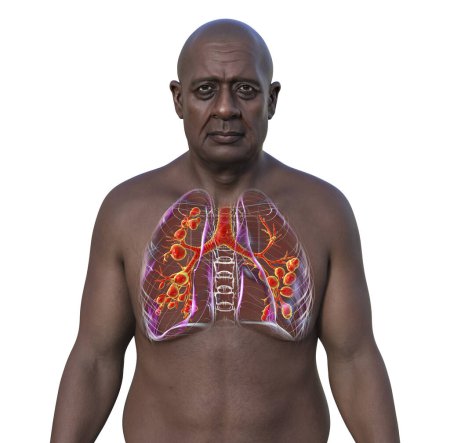A man with lungs affected by cystic fibrosis, a genetic disorder causing thick mucus production. 3D illustration shows bronchi dilation due to mucus accumulation and inflammation.