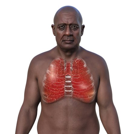 A 3D photorealistic illustration portraying an African man with transparent skin, showcasing his lungs affected by miliary tuberculosis, emphasizing the medical condition and ethnic representation.