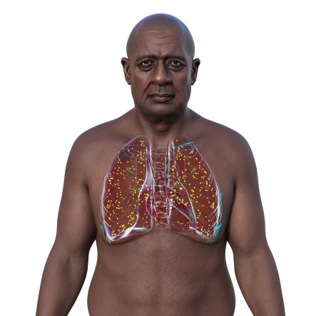 Téléchargez les photos : Illustration photoréaliste en 3D représentant un homme africain à la peau transparente, montrant ses poumons atteints de tuberculose miliaire, mettant l'accent sur la condition médicale et la représentation ethnique. - en image libre de droit