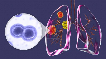 Lungenblastomykose mit Lungenläsionen und vergrößerten Bronchiallymphknoten und Nahaufnahme des Pilzes Blastomyces dermatitidis, 3D-Illustration.
