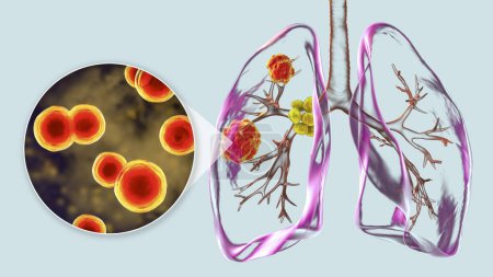 Lungenblastomykose mit Lungenläsionen und vergrößerten Bronchiallymphknoten und Nahaufnahme des Pilzes Blastomyces dermatitidis, 3D-Illustration.