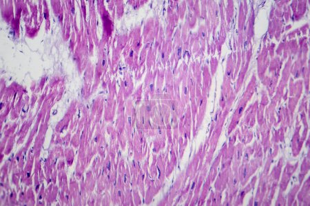 Photomicrograph of cardiac hypertrophy showing enlarged and thickened cardiac muscle fibers under the microscope.