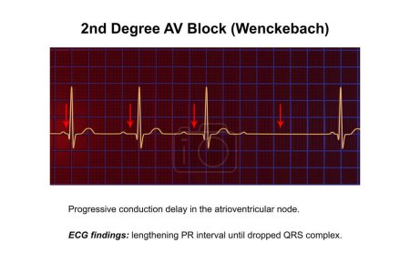 3D-Illustration zur Visualisierung eines EKGs des 2. Grades AV-Blocks (Wenckebach), das die abnorme elektrische Leitung im Herzrhythmus hervorhebt.