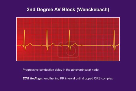 Ilustración 3D visualizando un ECG de bloqueo AV de segundo grado (Wenckebach), destacando una conducción eléctrica anormal en el ritmo cardíaco.