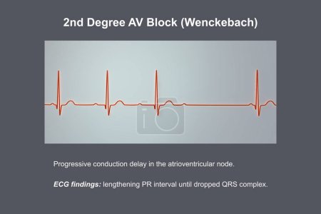 Illustration 3D visualisant un ECG du bloc AV du 2e degré (Wenckebach), mettant en évidence une conduction électrique anormale dans le rythme cardiaque.