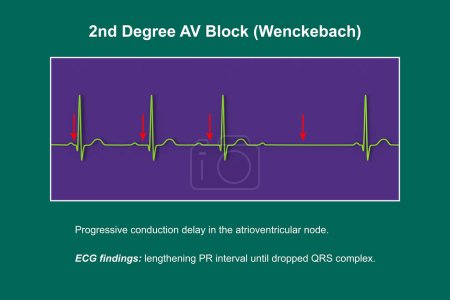 3D-Illustration zur Visualisierung eines EKGs des 2. Grades AV-Blocks (Wenckebach), das die abnorme elektrische Leitung im Herzrhythmus hervorhebt.