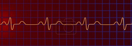 3D-Illustration zur Visualisierung eines EKGs mit Bündelverzweigungsblock, zeigt erweiterte QRS-Komplexe, veränderte ventrikuläre Depolarisation.