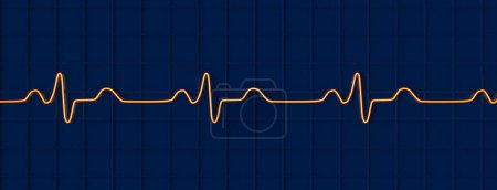 Illustration 3D visualisant un ECG avec bloc de branche Bundle, montrant des complexes QRS élargis, une dépolarisation ventriculaire altérée.