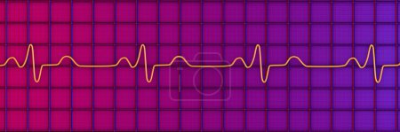 3D-Illustration zur Visualisierung eines EKGs mit Bündelverzweigungsblock, zeigt erweiterte QRS-Komplexe, veränderte ventrikuläre Depolarisation.