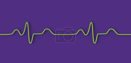 Foto de Ilustración 3D visualizando un ECG con bloqueo de rama del paquete, mostrando complejos QRS ampliados, despolarización ventricular alterada. - Imagen libre de derechos