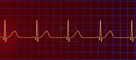 3D-Illustration eines Elektrokardiogramms (EKGs), das ein verlängertes QT-Intervall mit breit angelegten T-Wellen zeigt, charakteristisch für das Typ-1-Long-QT-Syndrom.