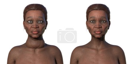 3D-Illustration vergleicht eine ältere afrikanische Frau mit Graves 'Krankheit (vergrößerte Schilddrüse, Exophthalmus) und ihrem gesunden Gegenstück.