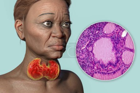 3D-Illustration einer älteren Frau mit Morbus Grave, die eine vergrößerte Schilddrüse und einen Exophthalmus darstellt, mit leichter Mikrographie des toxischen Kropfes.