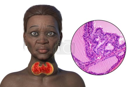 3D illustration of an elderly woman with Grave's disease, depicting enlarged thyroid gland and exophthalmos, with light micrograph of toxic goiter.