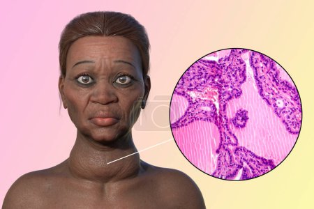 Téléchargez les photos : Illustration 3D d'une femme âgée atteinte de la maladie de Grave, représentant une hypertrophie de la glande thyroïde et une exophtalmie, avec micrographie photonique du goitre toxique. - en image libre de droit